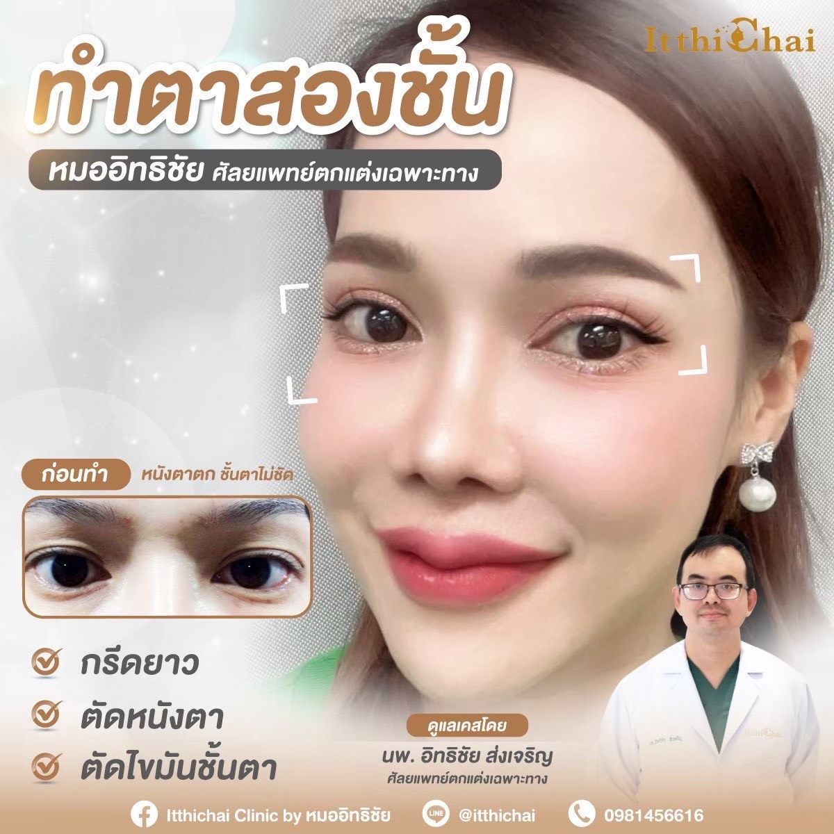ตาสองชั้น — Double Eyelid Surgery