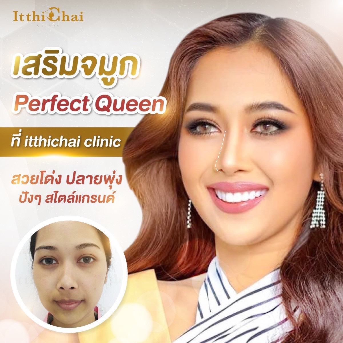เสริมจมูก — Rhinoplasty